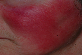 Rosacea redness severe