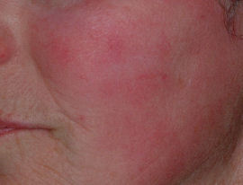 Facial redness clearing by Dr. Jay